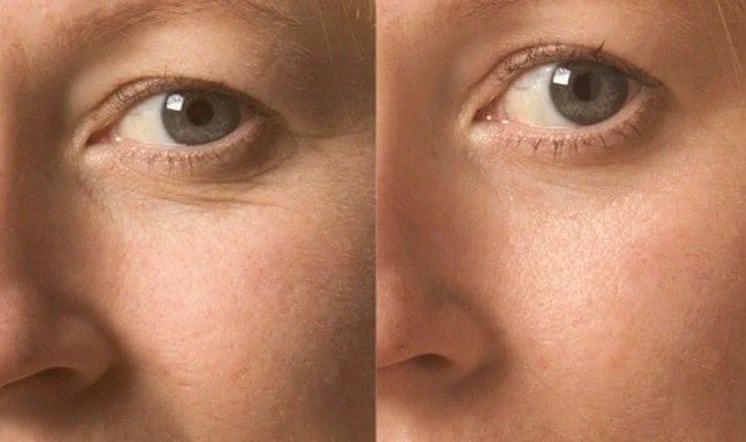 Биоревитализация кожи вокруг глаз