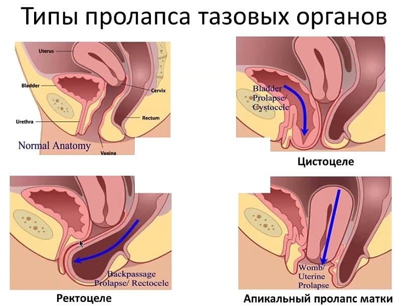 Пролапс тазовых органов у женщин