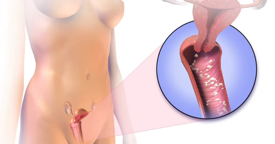 Лечение вагинального кандидоза (молочница)