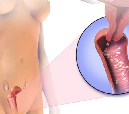 Лечение вагинального кандидоза (молочница)
