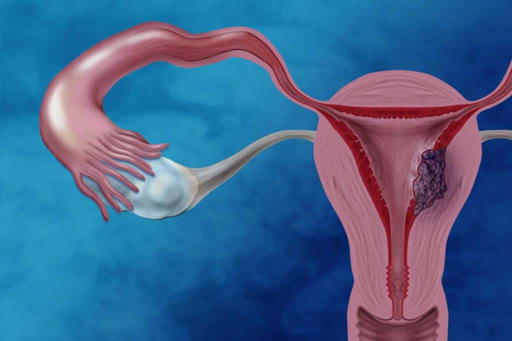 Рак тела матки