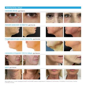Верните молодость и сияние своей кожи за одну процедуру с новым аппаратом ЭНДОЛИФТ!