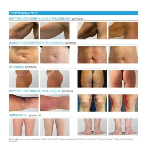 Верните молодость и сияние своей кожи за одну процедуру с новым аппаратом ЭНДОЛИФТ!